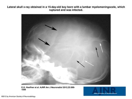 Lateral skull x-ray obtained in a 15-day-old boy born with a lumbar myelomeningocele, which ruptured and was infected. Lateral skull x-ray obtained in.