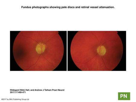 Fundus photographs showing pale discs and retinal vessel attenuation.