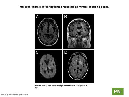 MR scan of brain in four patients presenting as mimics of prion disease. MR scan of brain in four patients presenting as mimics of prion disease. (A) C9orf72.