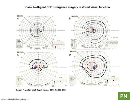 Case 2—Urgent CSF divergence surgery restored visual function.