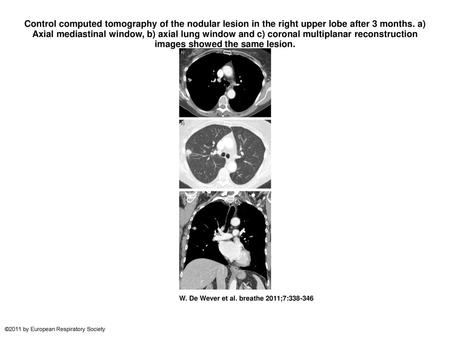 Control computed tomography of the nodular lesion in the right upper lobe after 3 months. a) Axial mediastinal window, b) axial lung window and c) coronal.