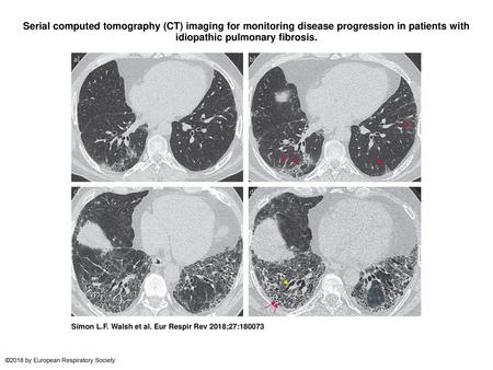 Serial computed tomography (CT) imaging for monitoring disease progression in patients with idiopathic pulmonary fibrosis. Serial computed tomography (CT)