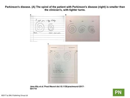 Parkinson’s disease. (A) The spiral of the patient with Parkinson’s disease (right) is smaller than the clinician’s, with tighter turns. Parkinson’s disease. (A)