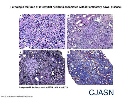 Pathologic features of interstitial nephritis associated with inflammatory bowel disease. Pathologic features of interstitial nephritis associated with.