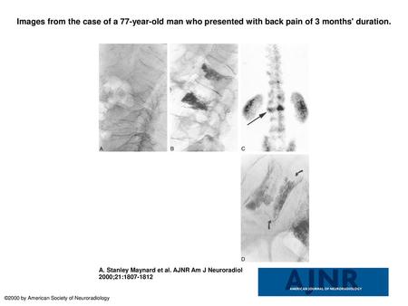 Images from the case of a 77-year-old man who presented with back pain of 3 months' duration. Images from the case of a 77-year-old man who presented with.