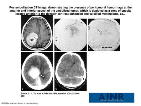 Postembolization CT image, demonstrating the presence of peritumoral hemorrhage at the anterior and inferior aspect of the embolized tumor, which is depicted.