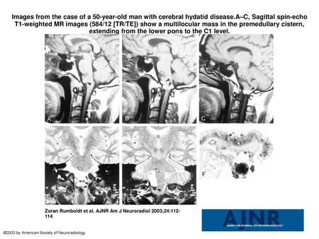 Images from the case of a 50-year-old man with cerebral hydatid disease.A–C, Sagittal spin-echo T1-weighted MR images (584/12 [TR/TE]) show a multilocular.