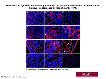 The increased cytosolic and nuclear β-catenin in the tubular epithelial cells of 7-d obstructed kidneys is suppressed by recombinant sFRP4. The increased.