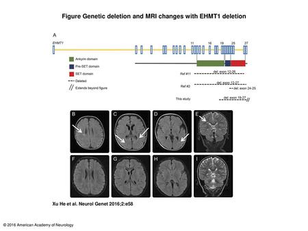 Figure Genetic deletion and MRI changes with EHMT1 deletion