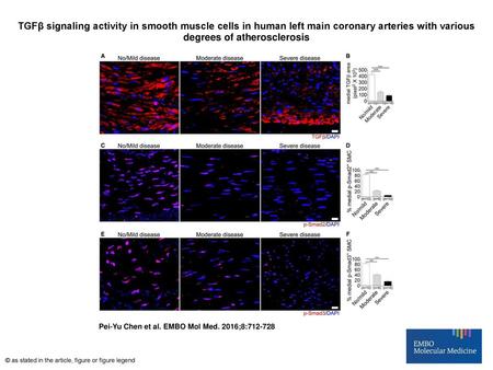 TGFβ signaling activity in smooth muscle cells in human left main coronary arteries with various degrees of atherosclerosis TGFβ signaling activity in.