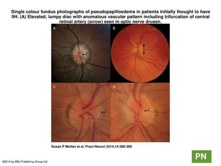 Single colour fundus photographs of pseudopapilloedema in patients initially thought to have IIH. (A) Elevated, lumpy disc with anomalous vascular pattern.