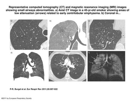 Representative computed tomography (CT) and magnetic resonance imaging (MRI) images showing small airways abnormalities. a) Axial CT image in a 45-yr-old.