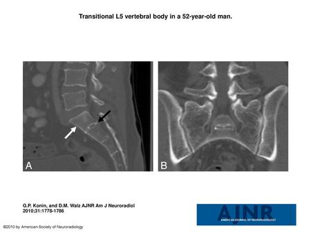 Transitional L5 vertebral body in a 52-year-old man.