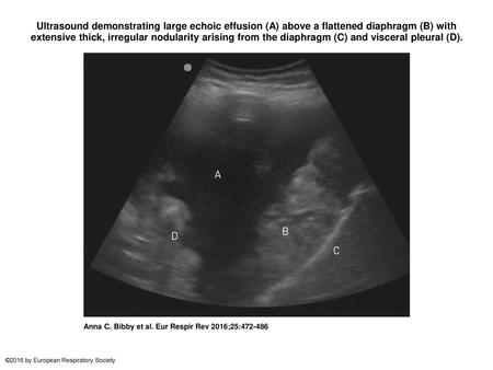 Ultrasound demonstrating large echoic effusion (A) above a flattened diaphragm (B) with extensive thick, irregular nodularity arising from the diaphragm.