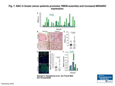 Fig. 7. NAC in breast cancer patients promotes TMEM assembly and increased MENAINV expression. NAC in breast cancer patients promotes TMEM assembly and.