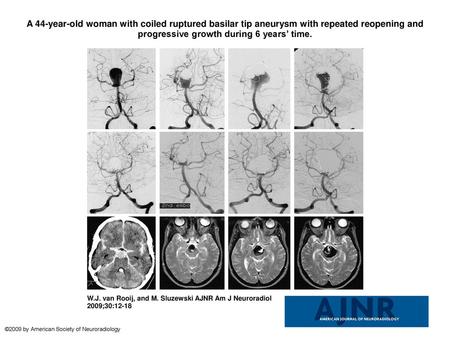 A 44-year-old woman with coiled ruptured basilar tip aneurysm with repeated reopening and progressive growth during 6 years’ time. A 44-year-old woman.