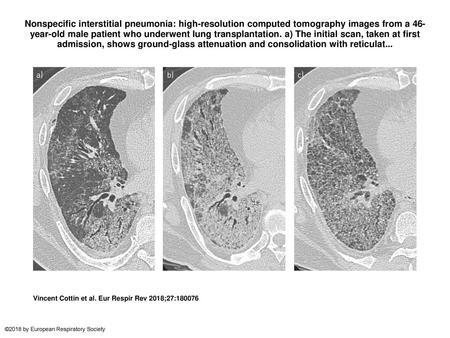 Nonspecific interstitial pneumonia: high-resolution computed tomography images from a 46-year-old male patient who underwent lung transplantation. a) The.