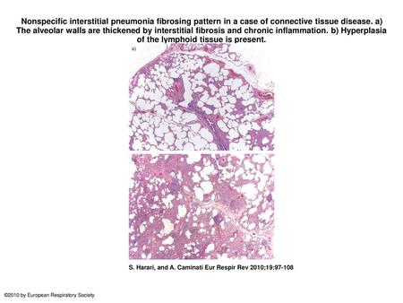 Nonspecific interstitial pneumonia fibrosing pattern in a case of connective tissue disease. a) The alveolar walls are thickened by interstitial fibrosis.