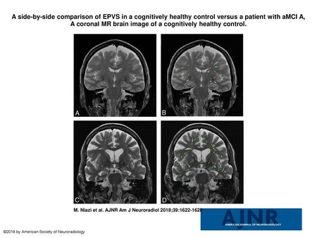 A side-by-side comparison of EPVS in a cognitively healthy control versus a patient with aMCI A, A coronal MR brain image of a cognitively healthy control.
