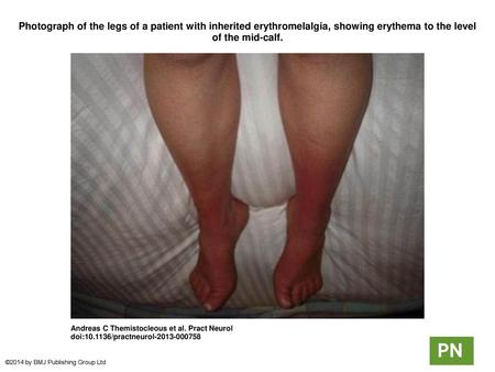 Photograph of the legs of a patient with inherited erythromelalgia, showing erythema to the level of the mid-calf. Photograph of the legs of a patient.
