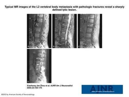 Typical MR images of the L2 vertebral body metastasis with pathologic fractures reveal a sharply defined lytic lesion. Typical MR images of the L2 vertebral.
