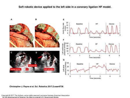 Soft robotic device applied to the left side in a coronary ligation HF model. Soft robotic device applied to the left side in a coronary ligation HF model.