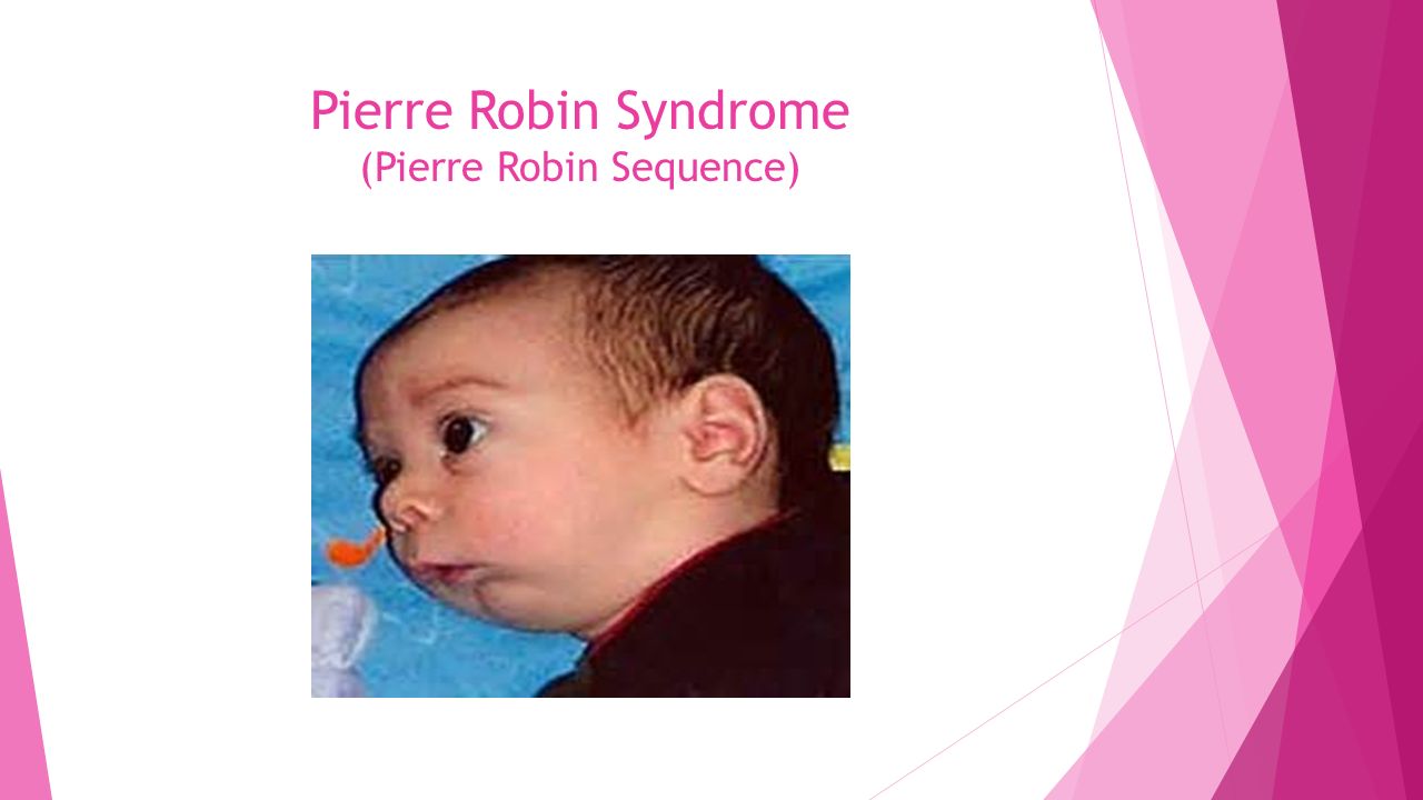 Pierre robin syndrome