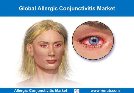 Allergic Conjunctivitis Market   Global Allergic Conjunctivitis Market.