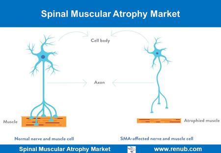 Spinal Muscular Atrophy Market   Spinal Muscular Atrophy Market.