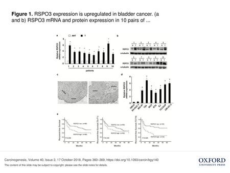 Figure 1. RSPO3 expression is upregulated in bladder cancer