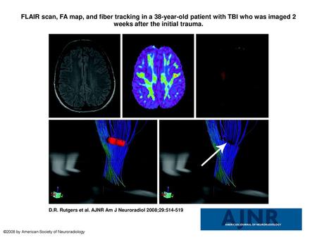 FLAIR scan, FA map, and fiber tracking in a 38-year-old patient with TBI who was imaged 2 weeks after the initial trauma. FLAIR scan, FA map, and fiber.