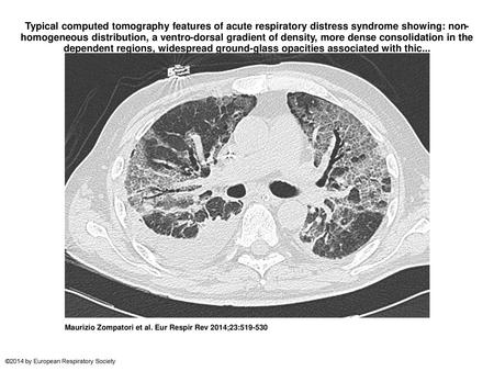 Typical computed tomography features of acute respiratory distress syndrome showing: non-homogeneous distribution, a ventro-dorsal gradient of density,
