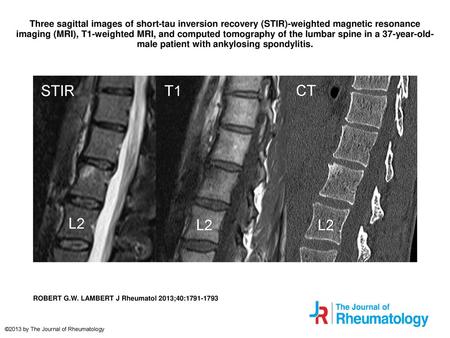 Three sagittal images of short-tau inversion recovery (STIR)-weighted magnetic resonance imaging (MRI), T1-weighted MRI, and computed tomography of the.