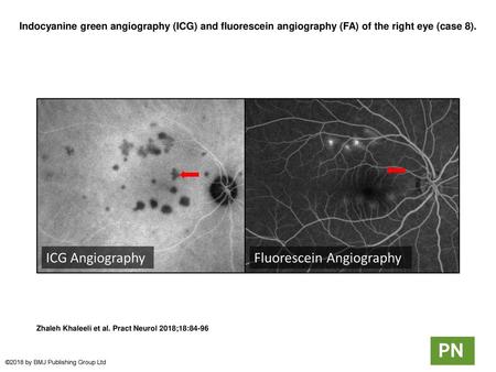 Indocyanine green angiography (ICG) and fluorescein angiography (FA) of the right eye (case 8). Indocyanine green angiography (ICG) and fluorescein angiography.