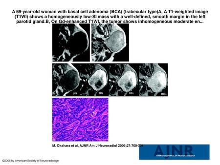 A 69-year-old woman with basal cell adenoma (BCA) (trabecular type)A, A T1-weighted image (T1WI) shows a homogeneously low-SI mass with a well-defined,