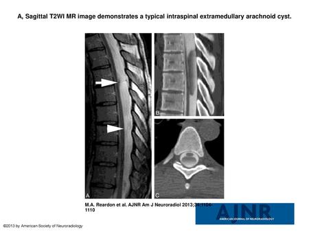 A, Sagittal T2WI MR image demonstrates a typical intraspinal extramedullary arachnoid cyst. A, Sagittal T2WI MR image demonstrates a typical intraspinal.