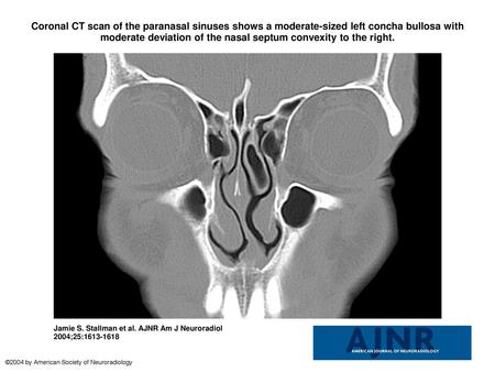Coronal CT scan of the paranasal sinuses shows a moderate-sized left concha bullosa with moderate deviation of the nasal septum convexity to the right.