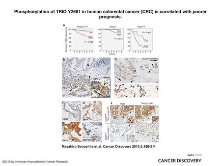 Phosphorylation of TRIO Y2681 in human colorectal cancer (CRC) is correlated with poorer prognosis. Phosphorylation of TRIO Y2681 in human colorectal cancer.