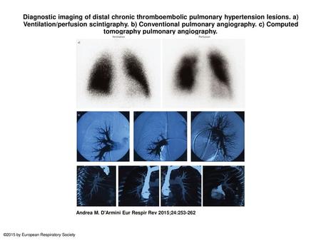 Diagnostic imaging of distal chronic thromboembolic pulmonary hypertension lesions. a) Ventilation/perfusion scintigraphy. b) Conventional pulmonary angiography.
