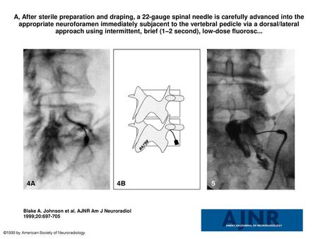 A, After sterile preparation and draping, a 22-gauge spinal needle is carefully advanced into the appropriate neuroforamen immediately subjacent to the.