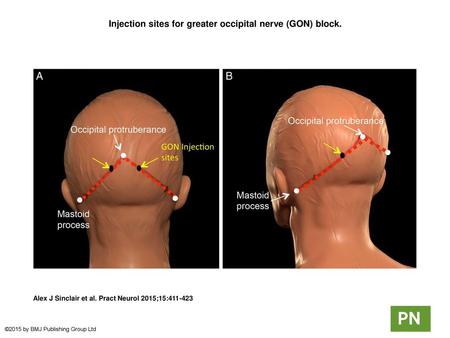 Injection sites for greater occipital nerve (GON) block.