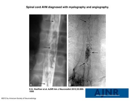 Spinal cord AVM diagnosed with myelography and angiography.