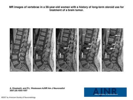MR images of vertebrae in a 58-year-old woman with a history of long-term steroid use for treatment of a brain tumor. MR images of vertebrae in a 58-year-old.