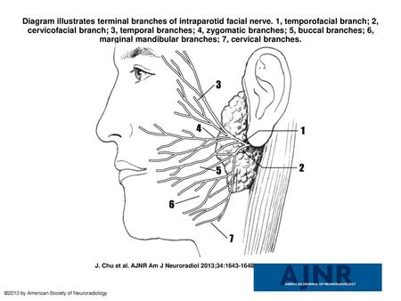Diagram illustrates terminal branches of intraparotid facial nerve