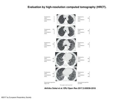 Evaluation by high-resolution computed tomography (HRCT).