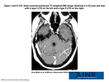 Types I and II LTS. Axial contrast-enhanced T1-weighted MR image obtained in a 55-year-old man with a type I LTS on the left and a type II LTS on the right.