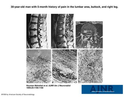 30-year-old man with 5-month history of pain in the lumbar area, buttock, and right leg. 30-year-old man with 5-month history of pain in the lumbar area,