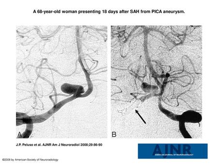 A 68-year-old woman presenting 18 days after SAH from PICA aneurysm.