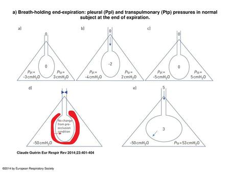 A) Breath-holding end-expiration: pleural (Ppl) and transpulmonary (Ptp) pressures in normal subject at the end of expiration. a) Breath-holding end-expiration: