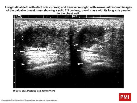 Longitudinal (left, with electronic cursors) and transverse (right, with arrows) ultrasound images of the palpable breast mass showing a solid 2.5 cm long,